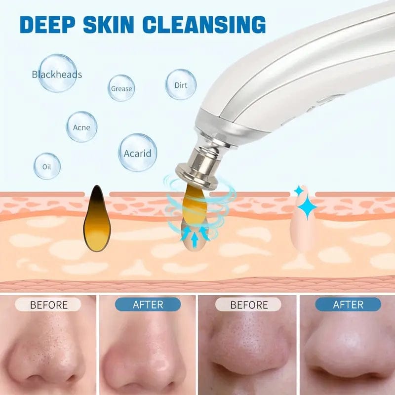 Upgraded Blackhead Remover – Pore Vacuum Cleaner with Adjustable Suction & 5 Probes